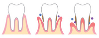 歯周病の種類